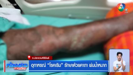 อุทาหรณ์ โรคเริม รักษาด้วยคาถา พ่นน้ำหมาก