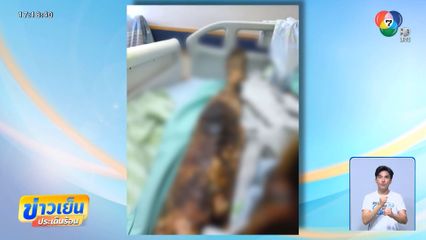 อันตราย "เห็บป่า" รุนแรงตัดขาทิ้ง