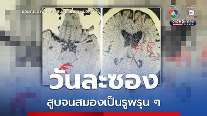 หมอยกเคสสมองเป็นรูพรุน ผลจากการสูบวันละซอง