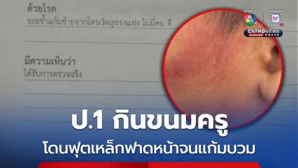 ป.1 กินขนมครู โดนฟุตเหล็กฟาดหน้าจนแก้มบวม