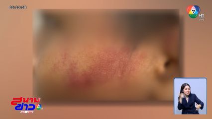 เจ็บแทนลูก ! ครูใช้ฟุตเหล็กตีหน้าช้ำ จ.ลำปาง