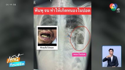 เตือนภัย ฟันผุเป็นเหตุให้ปอดมีหนอง