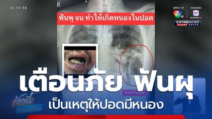 เตือนภัย ฟันผุเป็นเหตุให้ปอดมีหนอง