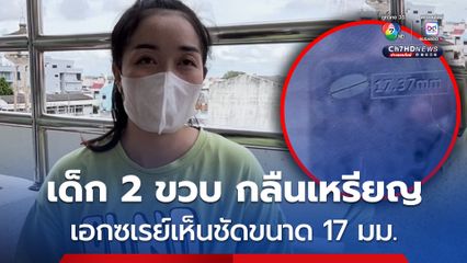 เด็กชาย 2 ขวบ กลืนเหรียญ ภาพเอกซเรย์เห็นชัดขนาด 17 มิลลิเมตร