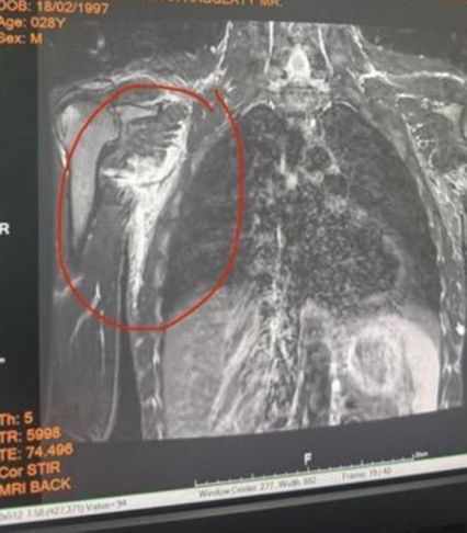 ONE Championship : โจนาธาน แฮ็กเกอร์ตี โชว์หลักฐานอาการเจ็บ เหตุถอนชก นาบิล อานาน ศึก ONE 173