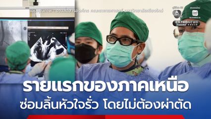 แพทย์ มช. รักษาหัวใจ ซ่อมลิ้นหัวใจไมตรัลรั่ว โดยไม่ต้องผ่าตัด สำเร็จรายแรกของภาคเหนือ 