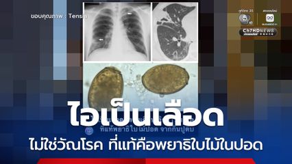 ไอเรื้อรังมาเป็นปี คิดว่าเป็นวัณโรคหรือมะเร็งปอด ที่แท้พยาธิใบไม้ในปอด