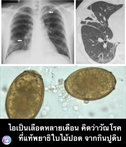 ไอเรื้อรังมาเป็นปี คิดว่าเป็นวัณโรคหรือมะเร็งปอด ที่แท้พยาธิใบไม้ในปอด