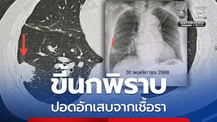 หมอมนูญ เตือนปอดอักเสบเชื้อราจากขี้นกพิราบ