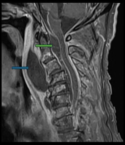 เคสนี้ถึงชีวิต ฟันผุเรื้อรังหนองกระจายทั่วโพรงหลังคอ เข้าไขสันหลัง