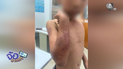 ป.4 โหดเกินเด็ก ทำร้ายเพื่อนบาดเจ็บ