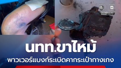 นทท.ขาไหม้ พาวเวอร์แบงก์ระเบิดคากระเป๋ากางเกง