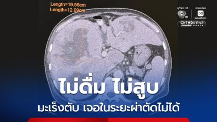 หมอมนูญยกเคสผู้ป่วยมะเร็งตับ ทั้งที่ดูแลสุขภาพไม่ดื่มเหล้า