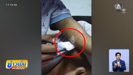 กระสุนฝังแขน หมอไม่รับผ่าตัด