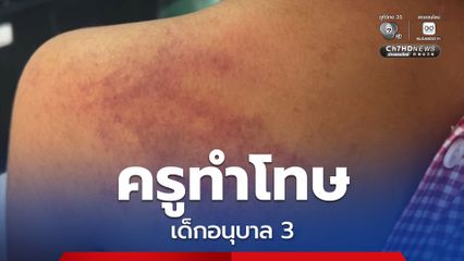 พ่อเล่าทั้งน้ำตา ลูกสาวอนุบาล 3 ถูกคุณครูทำโทษจนเป็นรอยช้ำ ซ้ำเด็กผวาไม่กล้าไปโรงเรียน