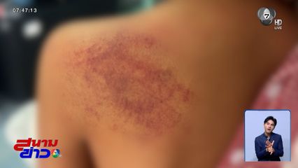 เกินกว่าเหตุ ? ครูทำโทษเด็กอนุบาล เจ็บไหล่บวมช้ำ ชี้แจงตีตักเตือนเบา ๆ