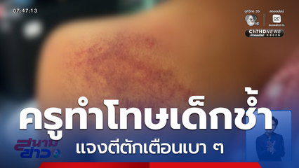 เกินกว่าเหตุ ? ครูทำโทษเด็กอนุบาล เจ็บไหล่บวมช้ำ ชี้แจงตีตักเตือนเบา ๆ