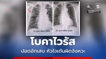 หมอมนูญยกเคสผู้ป่วยติดเชื้อโบคาไวรัส ปอดอักเสบ