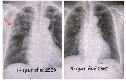 หมอมนูญยกเคสผู้ป่วยติดเชื้อโบคาไวรัส ปอดอักเสบ