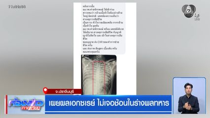 เผยผลเอกซเรย์ ไม่เจอช้อนในร่างพลทหาร จ.ปราจีนบุรี