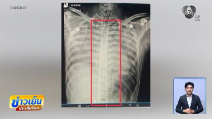 เผยผลเอกซเรย์ ไม่เจอช้อนในร่างพลทหาร จ.ปราจีนบุรี
