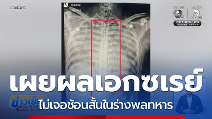เผยผลเอกซเรย์ ไม่เจอช้อนในร่างพลทหาร จ.ปราจีนบุรี