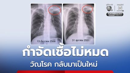 หมอมนูญ ยกเคสวัณโรคกลับมาเป็นใหม่ ยาในอดีตอาจกำจัดเชื้อไม่หมด