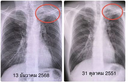 หมอมนูญ ยกเคสวัณโรคกลับมาเป็นใหม่ ยาในอดีตอาจกำจัดเชื้อไม่หมด