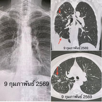 หมอมนูญ เผยช่วงนี้พบผู้ป่วยวัณโรคไทยรายใหม่เพิ่มขึ้นต่อเนื่อง