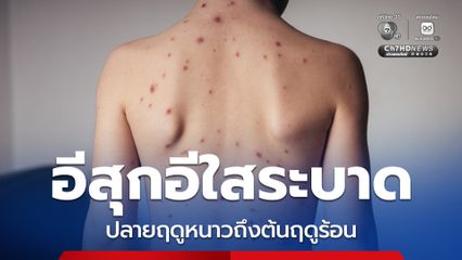 อีสุกอีใสระบาด ต้องระวังอาการแทรกซ้อน