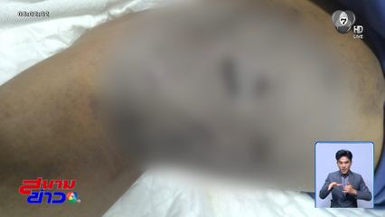 พิตบุลล์เขี้ยวดุ ขย้ำพนักงานส่งพัสดุ จ.ชลบุรี