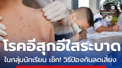 วิธีป้องกันลดเสี่ยง โรคสุกใสกลับมาระบาดในเด็กเล็ก วัยเรียน