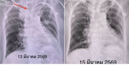ช่วงนี้ระบาด ไวรัส Parainfluenza ไม่รุนแรงแต่ต้องระวังเด็กเล็ก-คนแก่