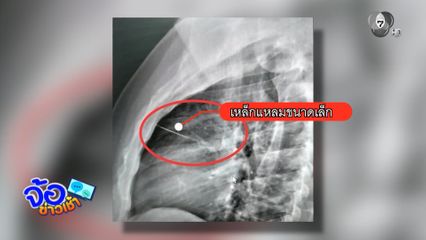 หนุ่มเพลียทิ้งตัวนอน เข็มแทงเฉียดหัวใจ