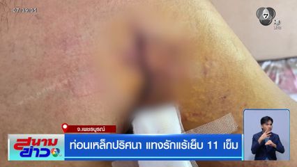 ท่อนเหล็กปริศนา แทงรักแร้เย็บ 11 เข็ม จ.เพชรบูรณ์