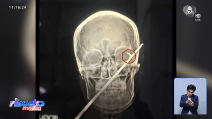 หนุ่มชักลูกดอกยิงกบ เจอย้อนศรแทงเบ้าตา จ.บุรีรัมย์