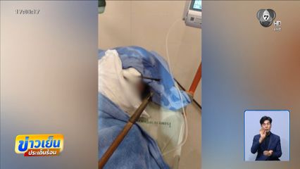 หนุ่มถูกยิงลูกดอกปักหน้า ปลอดภัยแล้ว จ.นครราชสีมา