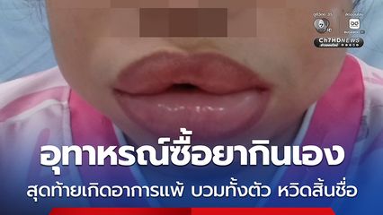 อุทาหรณ์ซื้อยากินเอง สุดท้ายเกิดอาการแพ้ บวมทั้งตัว หวิดสิ้นชื่อ
