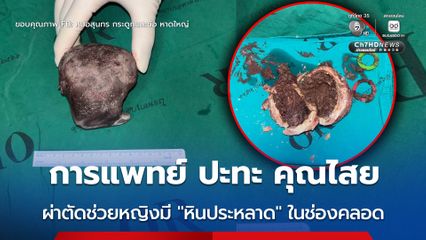 ทีมแพทย์ รพ.ศูนย์หาดใหญ่ ผ่าตัดช่วยหญิงวัย 47 ปี มี “ก้อนหิน” ในช่องคลอด ทางผู้ป่วยเผยเคยไปอยู่อินโดนีเซีย ถูกหมอผีบังคับทำของใส่เข้าช่องคลอด