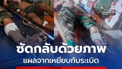 ทภ.2 โต้กัมพูชา ภาพบาดแผลทหารเขมรสอดคล้องกับการเหยียบกับระเบิด