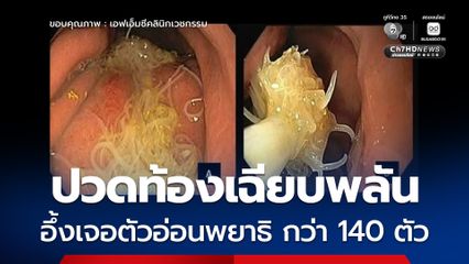 หญิงวัย 43 ปี มีอาการปวดท้องเฉียบพลัน หลังกินปลาดาบเงินย่าง มีอาการภายใน 24 ชั่วโมง พบตัวอ่อนพยาธิ กว่า 140 ตัว ในกระเพาะอาหาร