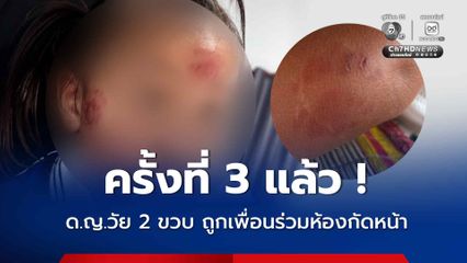 ครั้งที่ 3 แล้ว ด.ญ.วัย 2 ขวบ ถูกเพื่อนร่วมห้องกัดหน้า