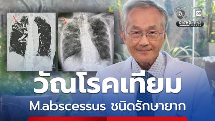หมอมนูญ ยกเคสผู้ป่วยวัณโรคเทียม M.abscessus ชนิดรักษายาก