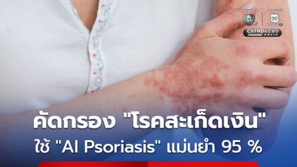 AI Psoriasis ช่วยคัดกรองโรคสะเก็ดเงิน ผ่านภาพถ่าย แม่นยำถึง 95 %