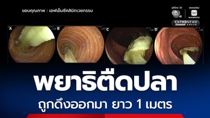 กินปลาดิบ ส่องกล้องลำไส้ใหญ่เจอพยาธิตืดปลา ยาว 1 เมตร