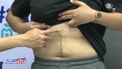 ร้อง รพ.ดังผ่าตัดพลาด ทำท่อน้ำดีเสียหาย
