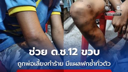 ช่วย ด.ช.12 ขวบ ถูกพ่อเลี้ยงทำร้าย มีแผลฟกช้ำทั่วตัว