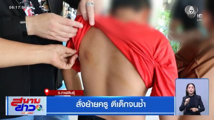 สั่งย้ายครู ตีเด็กจนช้ำ จ.กาฬสินธุ์