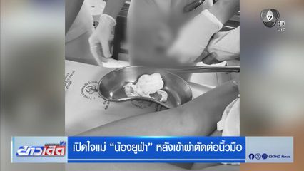 เปิดใจแม่ “น้องยูฟ่า” หลังเข้าผ่าตัดต่อนิ้วมือ